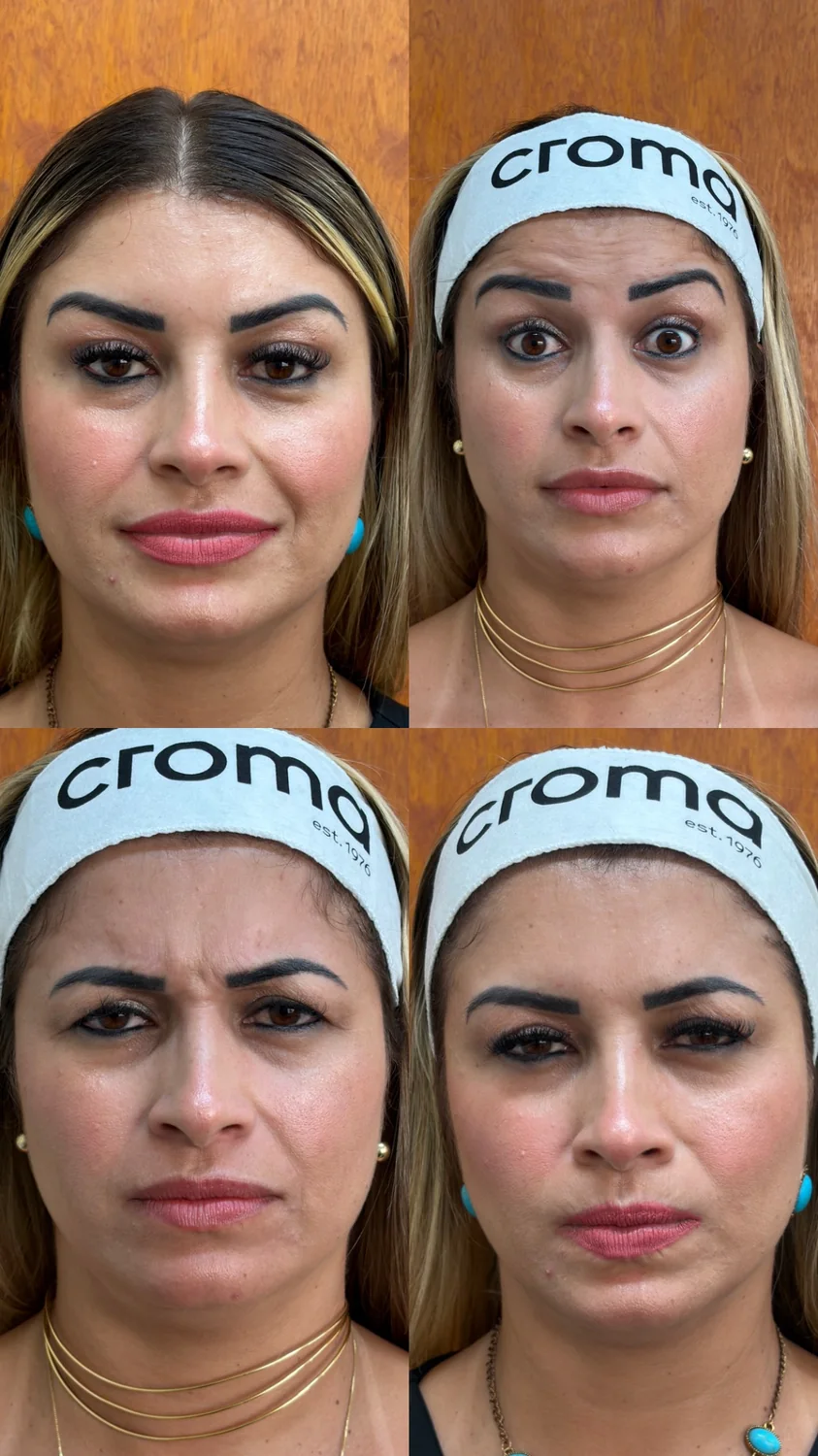 Resultado de Botox para rugas e linhas de expressão