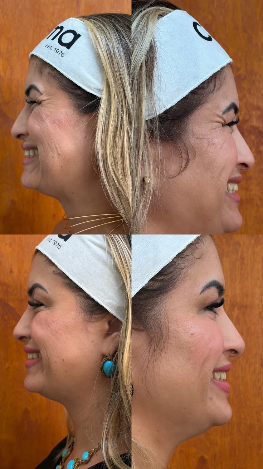 Botox antes e depois vista lateral