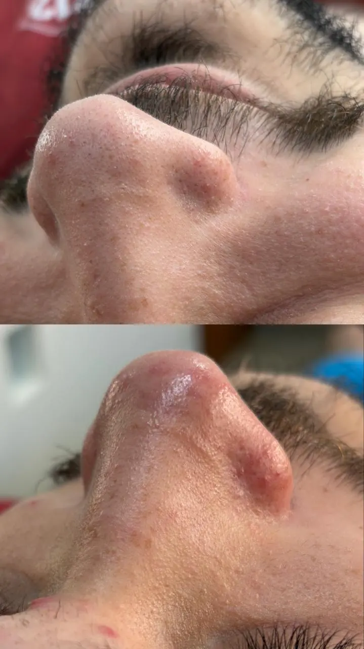 Antes e depois de limpeza de pele em Fernandópolis