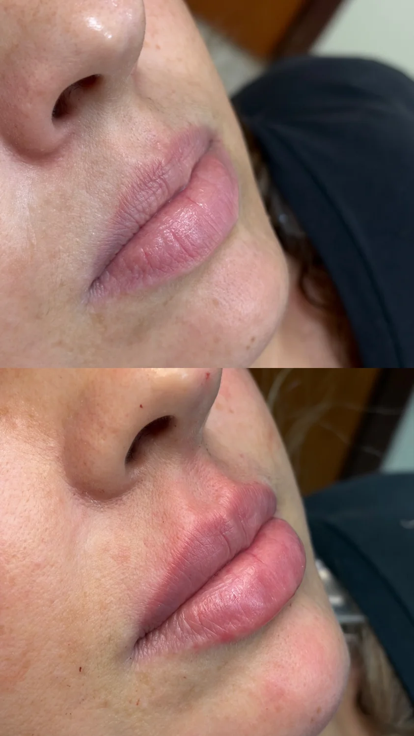 Antes e depois de preenchimento labial em Fernandópolis