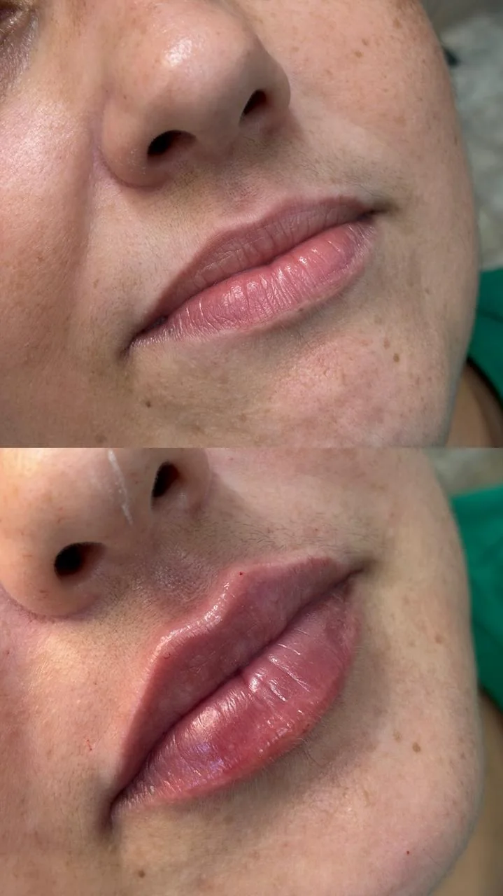 Resultado de preenchimento labial natural