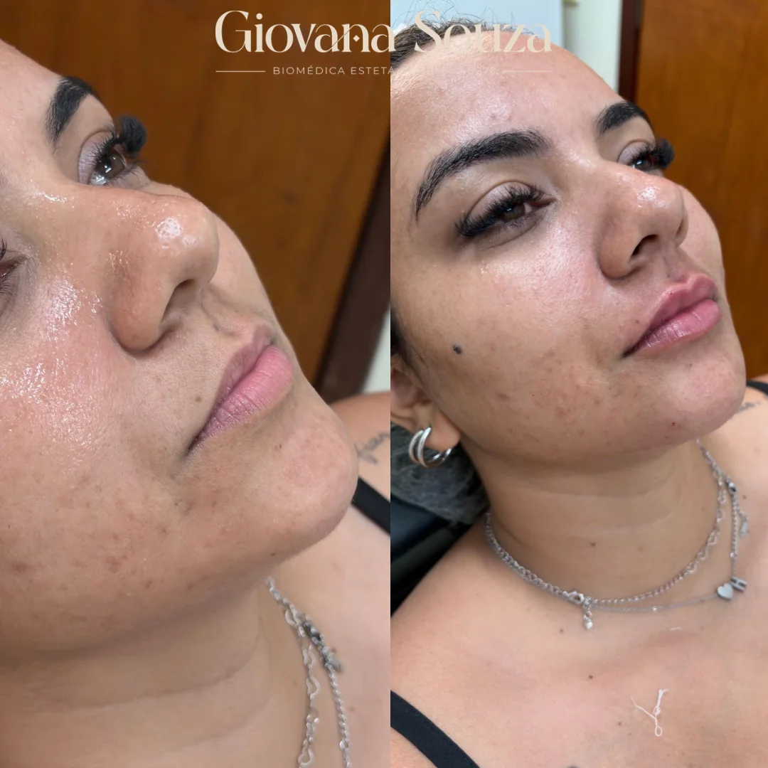 Preenchimento labial antes e depois