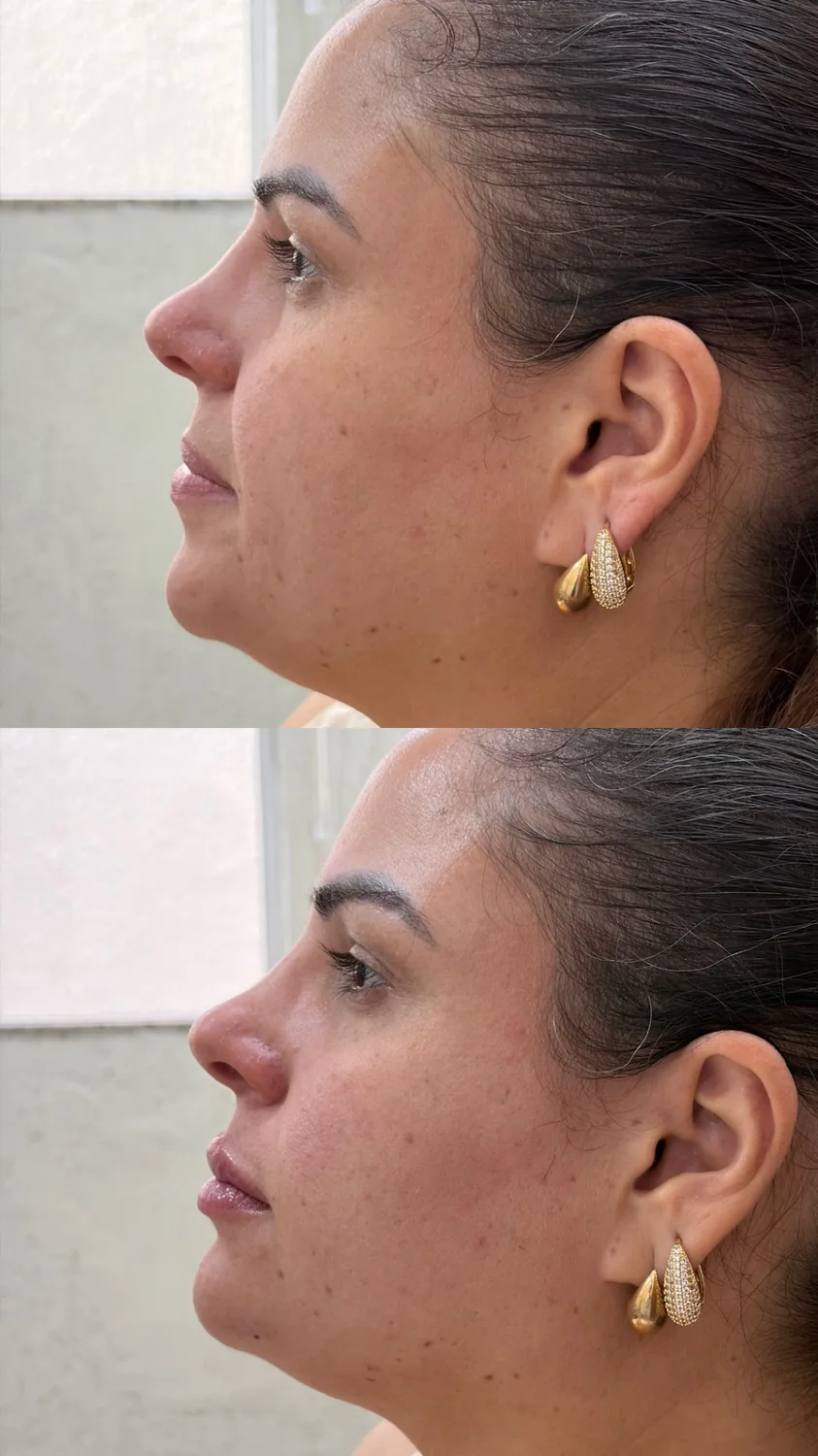 Antes e depois preenchimento labial e queixo